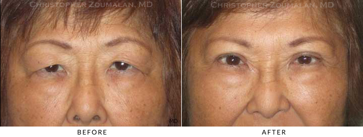 Asian Eyelid (Double Eyelid) Surgery Before & After Photo -  - Patient 22