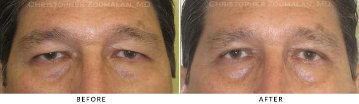 Asian Eyelid (Double Eyelid) Surgery Before & After Photo -  - Patient 23