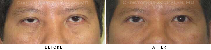 Asian Eyelid (Double Eyelid) Surgery Before & After Photo -  - Patient 26