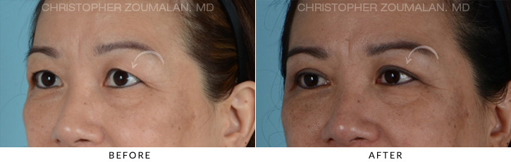 Asian Eyelid (Double Eyelid) Surgery Before & After Photo - Patient Seeing Side - Patient 4A