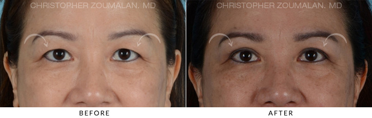 Asian Eyelid (Double Eyelid) Surgery Before & After Photo - Patient Seeing Straight - Patient 4B