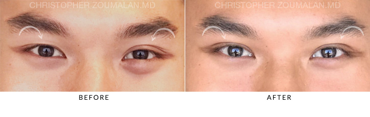 Asian Eyelid (Double Eyelid) Surgery Before & After Photo -  - Patient 5