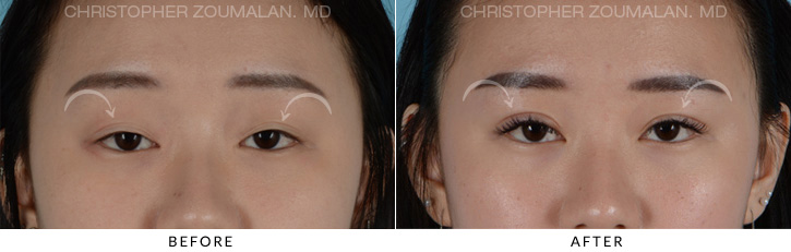 Asian Eyelid (Double Eyelid) Surgery Before & After Photo - Patient Seeing Straight - Patient 4A
