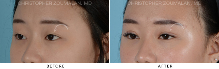 Asian Eyelid (Double Eyelid) Surgery Before & After Photo - Patient Seeing Side - Patient 6B