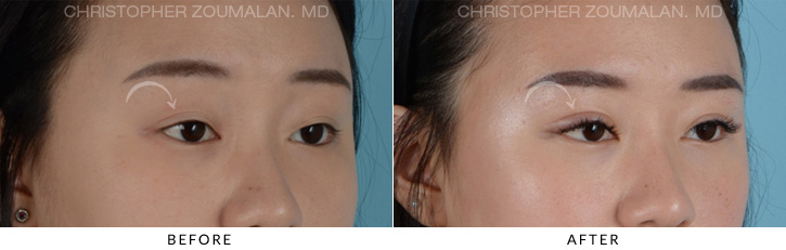 Asian Eyelid (Double Eyelid) Surgery Before & After Photo - Patient Seeing Side - Patient 6C