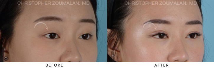 Asian Eyelid Double Eyelid Surgery Before and After Photo Gallery