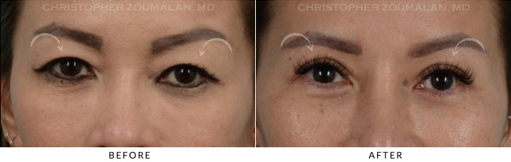 Asian Eyelid (Double Eyelid) Surgery Before & After Photo - Patient Seeing Straight - Patient 7A