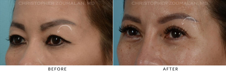 Asian Eyelid (Double Eyelid) Surgery Before & After Photo - Patient Seeing Side - Patient 5B