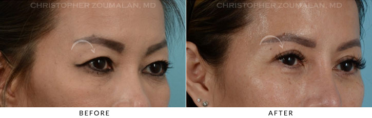 Asian Eyelid (Double Eyelid) Surgery Before & After Photo - Patient Seeing Side - Patient 5C