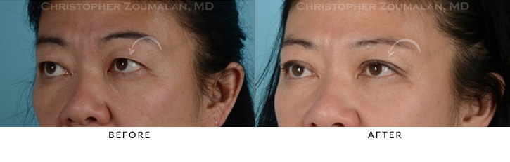 Asian Eyelid (Double Eyelid) Surgery Before & After Photo -  - Patient 8