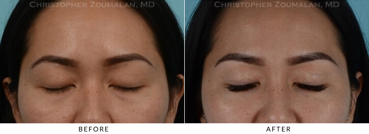 Asian Eyelid (Double Eyelid) Surgery Before & After Photo - Patient with Eyes Closed - Patient 9B