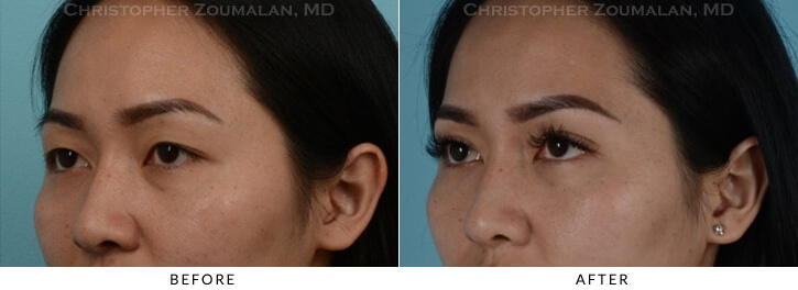 Asian Eyelid (Double Eyelid) Surgery Before & After Photo - Patient Seeing Side - Patient 9C