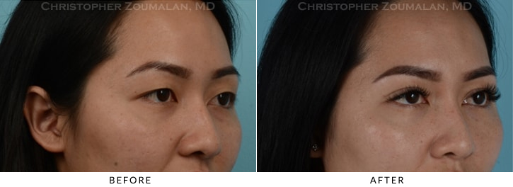 Asian Eyelid (Double Eyelid) Surgery Before & After Photo - Patient Seeing Side - Patient 9D