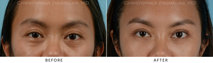 Asian Eyelid (Double Eyelid) Surgery Before & After Photo - Patient Seeing Straight - Patient 10A