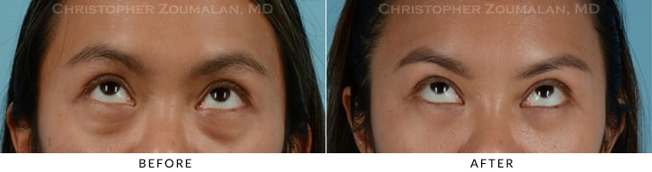 Asian Eyelid (Double Eyelid) Surgery Before & After Photo - Patient Seeing Up - Patient 10B