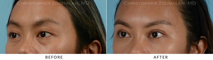 Asian Eyelid (Double Eyelid) Surgery Before & After Photo - Patient Seeing Side - Patient 10C