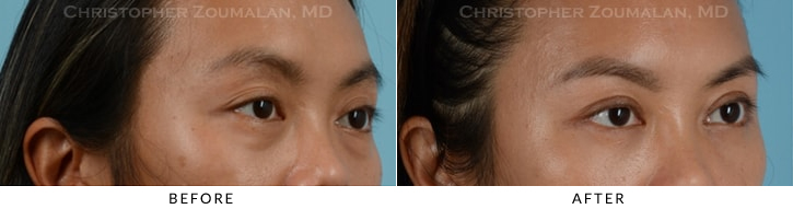 Asian Eyelid (Double Eyelid) Surgery Before & After Photo - Patient Seeing Side - Patient 10D