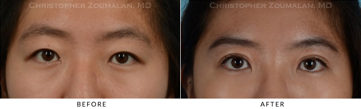 Asian Eyelid (Double Eyelid) Surgery Before & After Photo - Patient Seeing Straight - Patient 11A