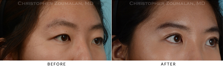 Asian Eyelid (Double Eyelid) Surgery Before & After Photo - Patient Seeing Side - Patient 11B