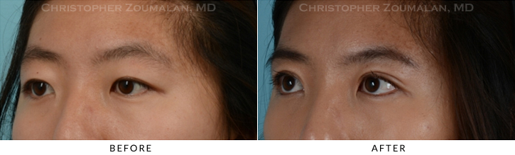 Asian Eyelid (Double Eyelid) Surgery Before & After Photo - Patient Seeing Side - Patient 11C