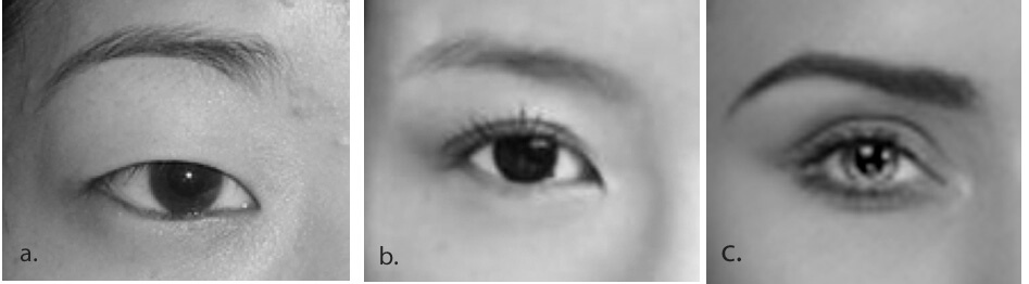 the picture below illustrate three basic types of eyelid creases