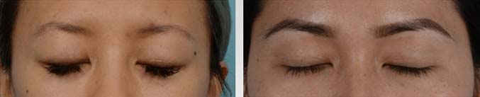 An Asian Eyelid Surgery (Double Eyelid Surgery) is performed with the utmost precision and care to ensure minimal scarring - female Patient before and after picture