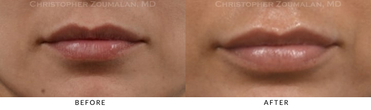 She desired more full lips and some definition to the border of her lips. Juvederm was used to help achieve this - Before and after pic of the patient.