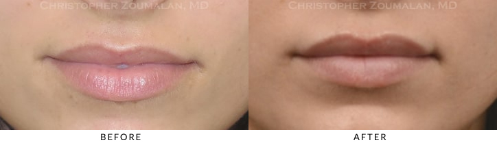 She desired to have more full and symmetric lips. Juvederm was used to help augment the lips - Before and after pic of the patient.