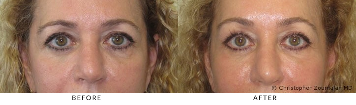 Endoscopic brow lift, periorbital and midface fat grafting, lower lid chemical peel (TCA 30%) - Patient before and after picture