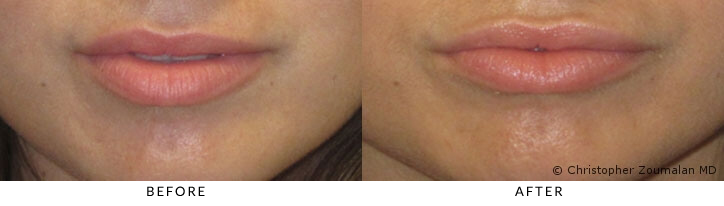 Lip Injections Beverly Hills Non Surgical Lip Augmentation La