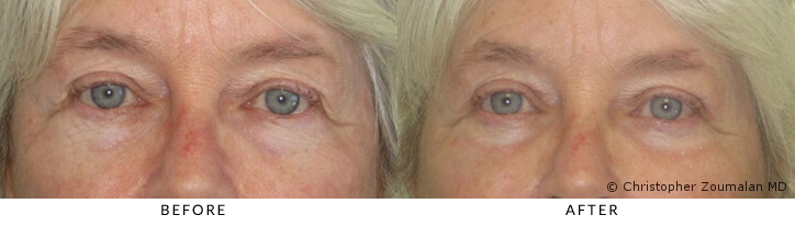 Bilateral upper and lower lid blepharoplasty, chemical peel to lower lid - Patient before and after picture.