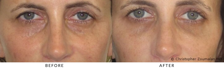 eyes dark circles before after