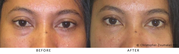 Hyaluronic acid (HA) fillers to orbital rim (tear trough) and midface. - Patient before and after picture