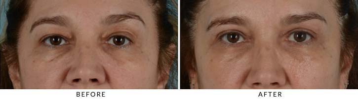 This patient had slowly growing cholesterol deposits, termed xanthelasmas, She wished to have them removed at the same time as an upper eyelid blepharoplasty - female patient before and after picture