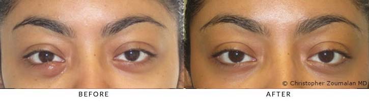 Right lower lid chalazion