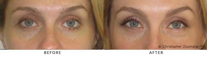 Full thickness wedge excision of left eyelid lesion with eyelid reconstruction - female patient before and after picture