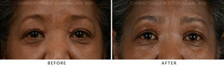 Benign Eyelid Lesions Before & After Photo - Patient Seeing Straight - Patient 1A