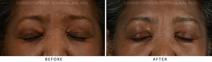 Benign Eyelid Lesions Before & After Photo - Patient close eyes - Patient 1B