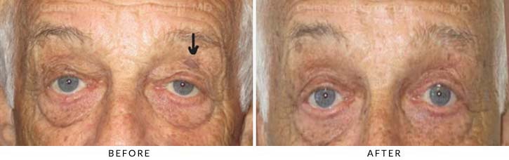 Benign Eyelid Lesions Before & After Photo - Patient Seeing Straight - Patient 5