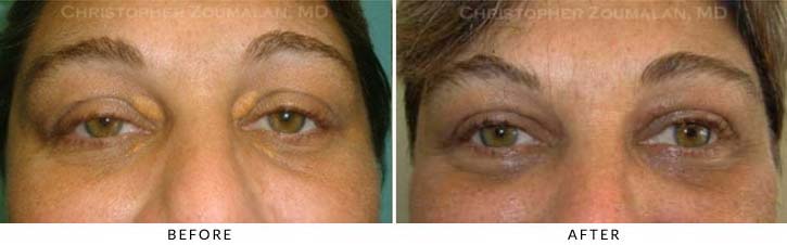Benign Eyelid Lesions Before & After Photo - Patient Seeing Straight - Patient 6
