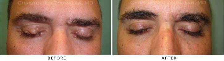 Benign Eyelid Lesions Before & After Photo - Patient close eyes - Patient 7
