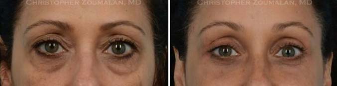 Lower brow lift - female patient before and after picture