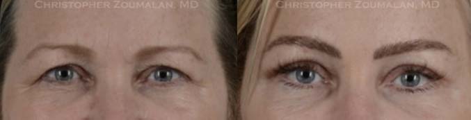 This patient underwent an endoscopic brow lift with endotine implants and an upper eyelid blepharoplasty- female patient before and after picture
