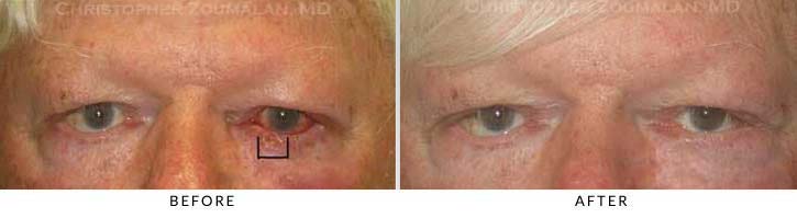 The patient had over 33% loss of his lower lid from the Mohs surgery, Dr. Zoumalan performed eyelid reconstructive surgery to help repair the defect - male patient before and after picture