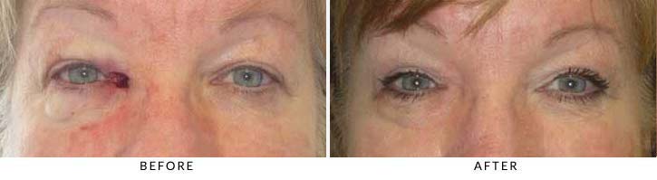 This patient had a biopsy proven right medial canthal (eyelid) basal cell skin cancer, It was removed by a Mohs trained dermatologist - female patient before and after picture