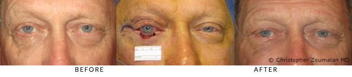Right lower lid excision of basal cell carcinoma and reconstruction using a myocutaneous advancement flap - male patient before and after picture