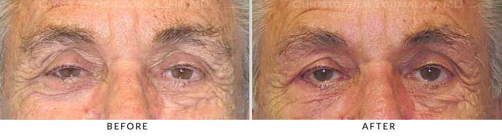 patient had a right lower eyelid that was turning inward and resulting in significant discomfort, tearing, and eye pain - male patient before and after picture