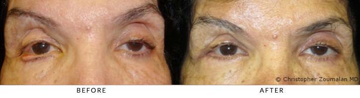 Ectropion repair, right lower lid. She underwent a right lower lid ectropion repair and using a special resuspension and tightening technique referred to as a canthoplasty - female patient before and after picture