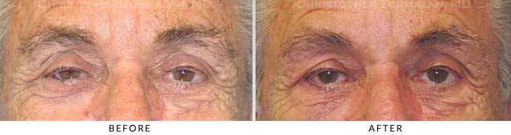 Ectropion and Entropion Before & After Photo -  - Patient 1