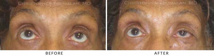 Ectropion and Entropion Before & After Photo -  - Patient 2